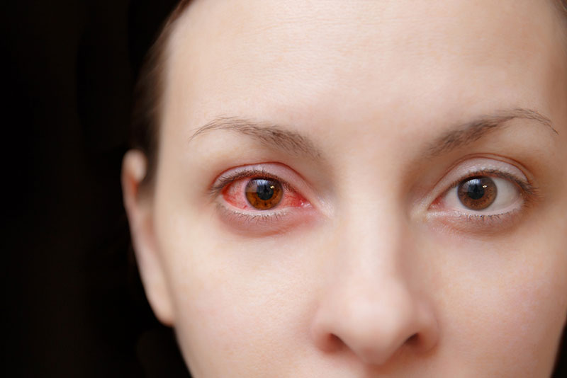 Conjuntivite viral unilateral