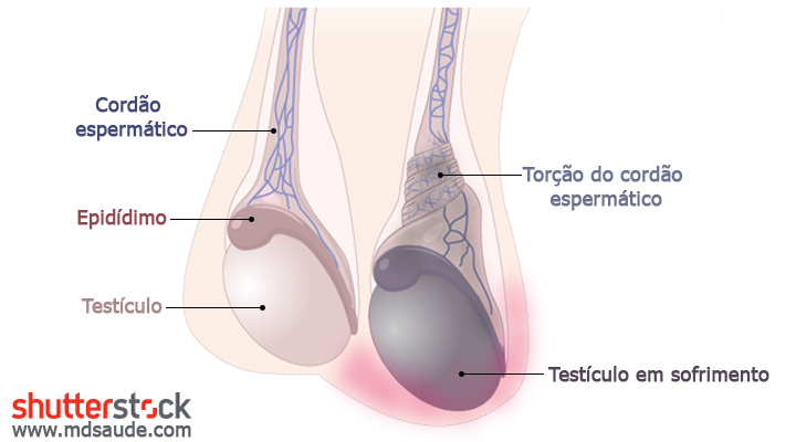 Como ocorre a torção testicular - ilustração