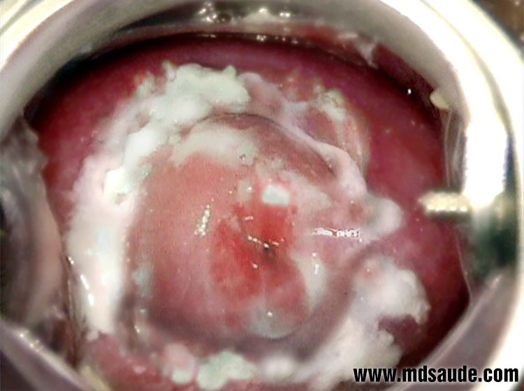 Cuello uterino con secreción blanquecina, con zonas parecidas queso cottage - candidiasis