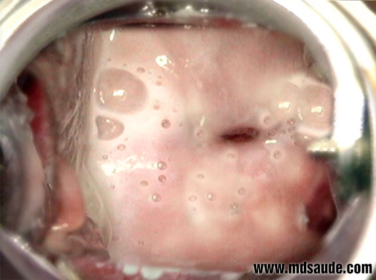 Corrimento vaginal amarelado por Trichomonas vaginalis