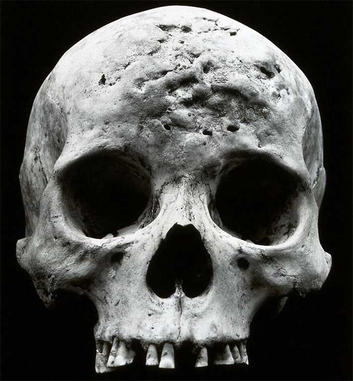 Effects of tertiary syphilis on a patient's skull