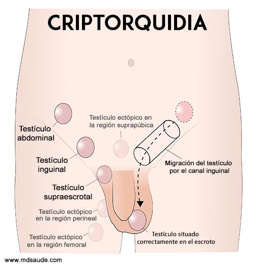 Tipos de criptorquidia