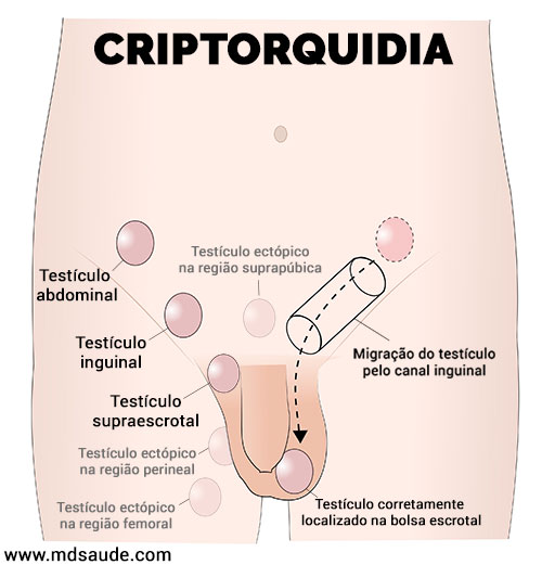 Criptorquidia - locais mais comuns