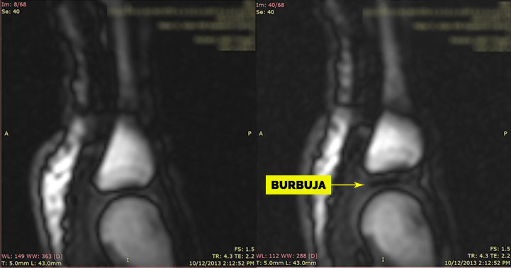 Burbuja en la articulación