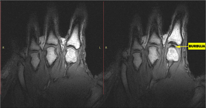 Burbuja en la articulación de la mano