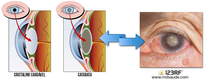 Olho com catarata