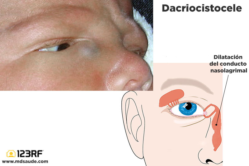 Dacriocistocele