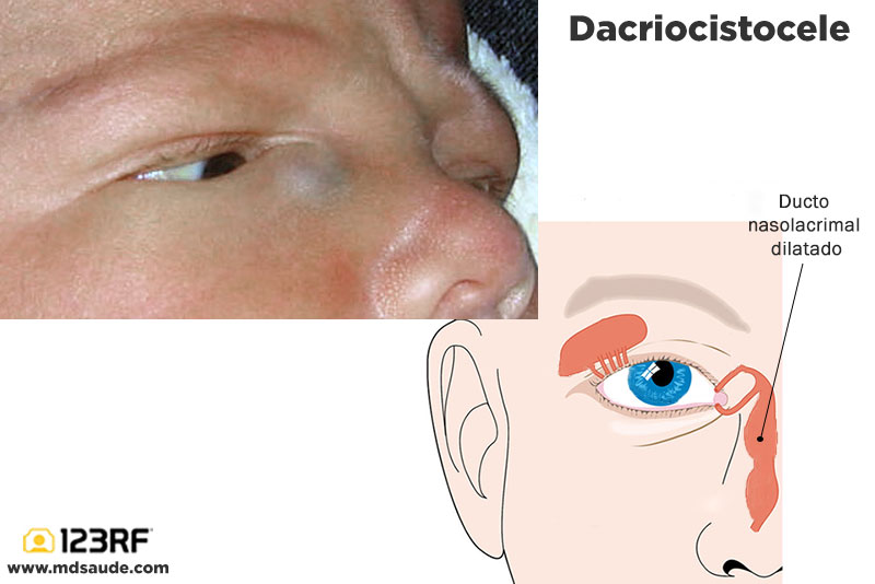 Dacriocistele