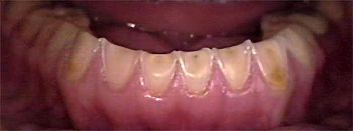 Erosión dental en la bulimia