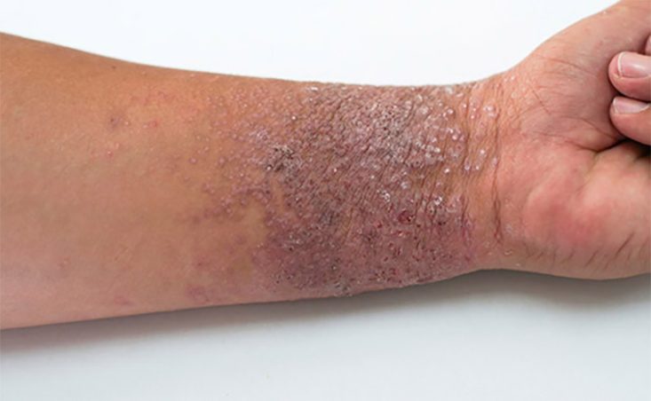 Lesão espessada no punho com ressecamento da pele - eczema atópico