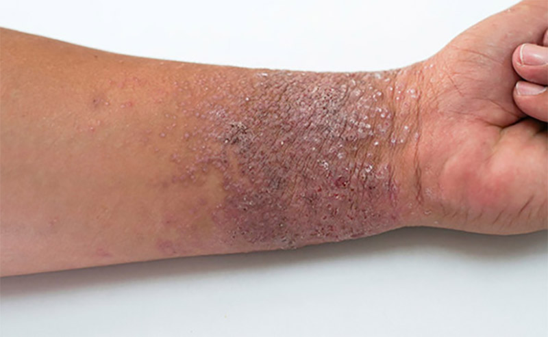 Lesão localizada e liquenificada da dermatite atópica no punho