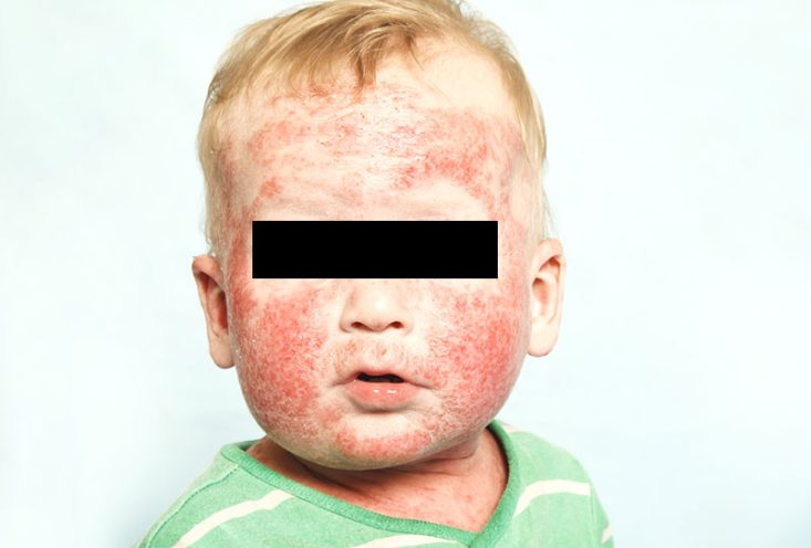 Dermatitis atópica infantil que afecta a toda la cara