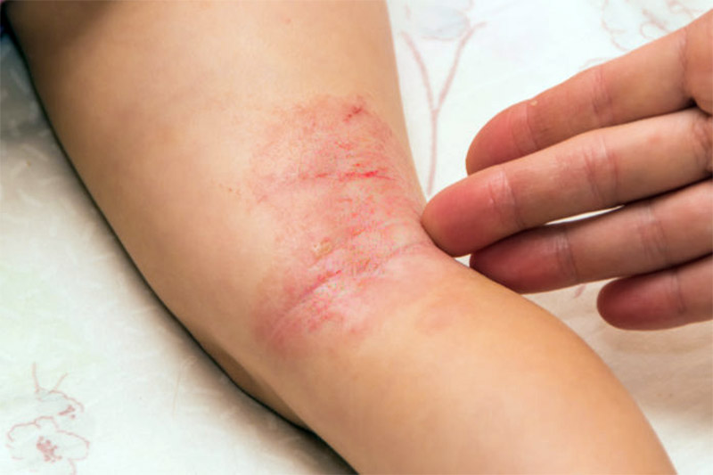 Eczema atópico na região poplítea