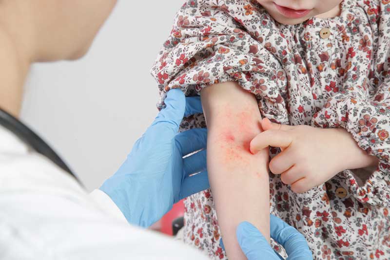 Eczema atópico na fossa cubital