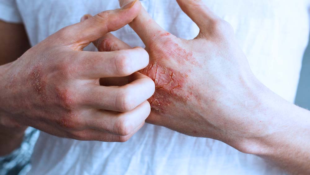 Fotos de dermatite atópica (bebês, crianças e adultos)