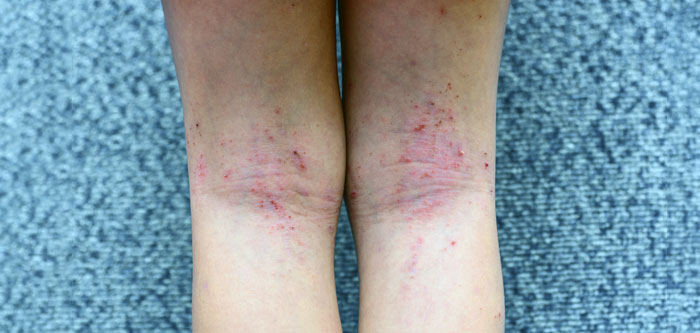 Dermatite atópica em área de dobra da pele