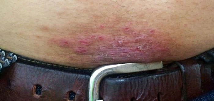 Dermatite de contato
