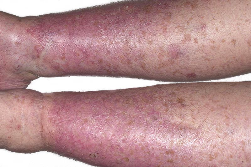 Dermatitis por estasis