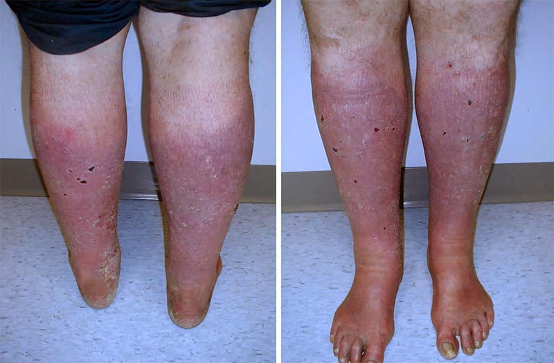 Dermatite de estase