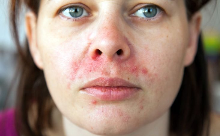 Dermatite perioral com pápulas e pústulas