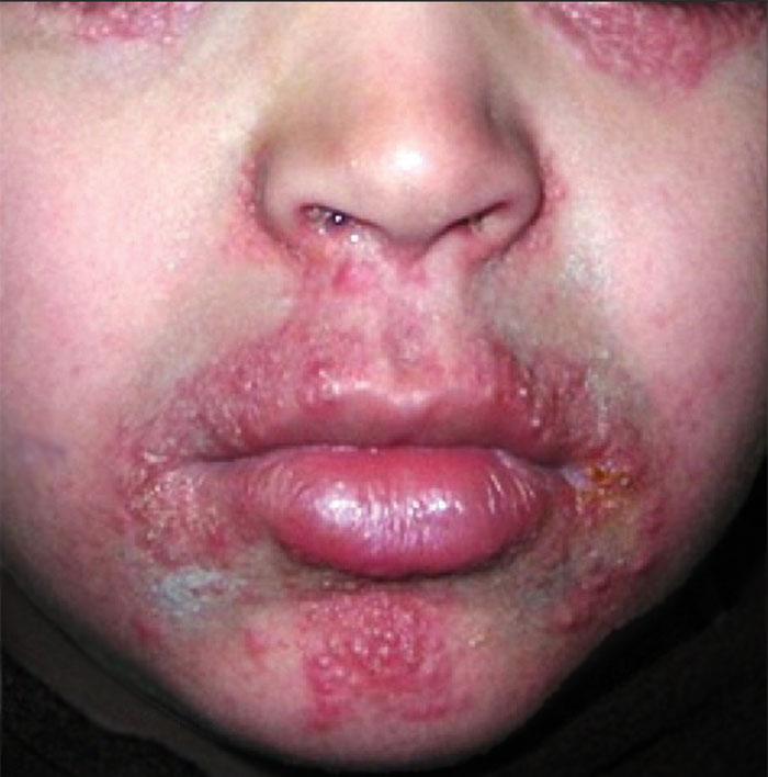 Dermatite periorificial granulomatosa envolvendo região perioral, perinasal e periorbital.
