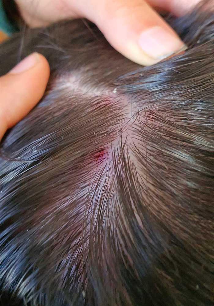 Dermatitis seborreica en el cuero cabelludo con caspa