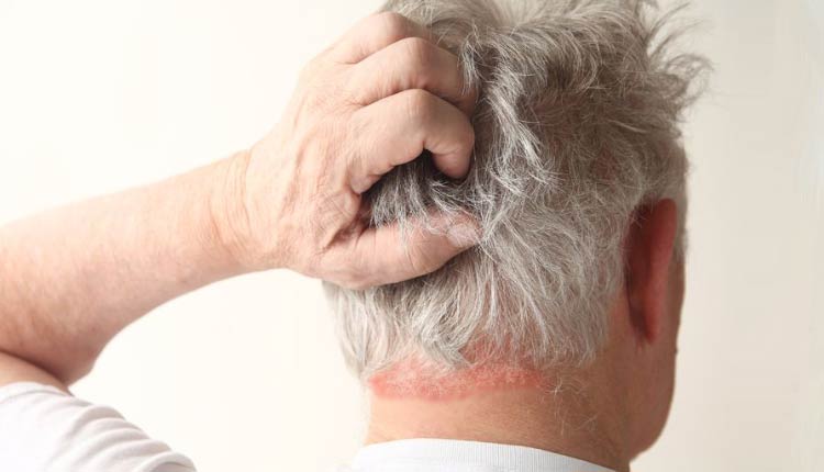 dermatitis seborreica