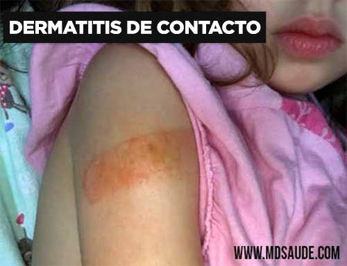 Dermatitis de contacto