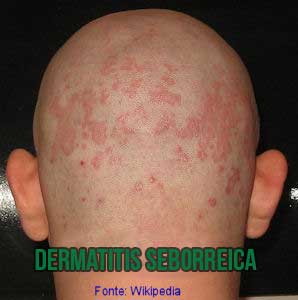 Dermatitis seborreica en el cuero cabelludo