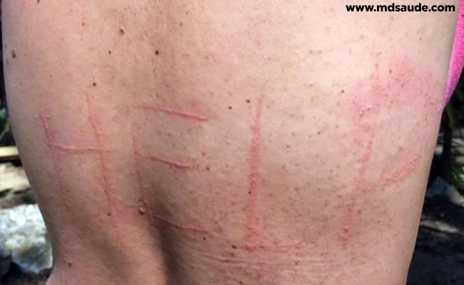 Dermatografismo