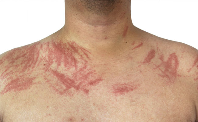 Dermatografia