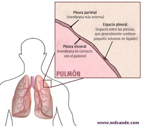 Derrame pleural