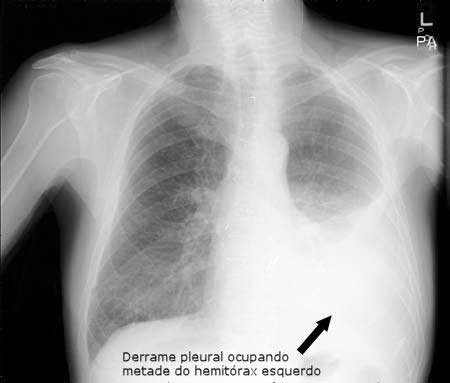 derrame pleural rx
