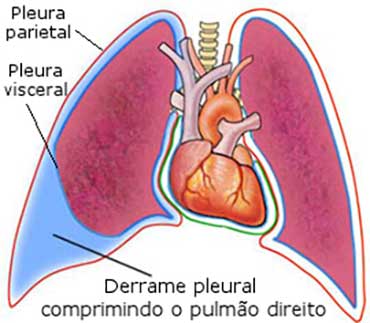 Derrame pleural no pulmão direito