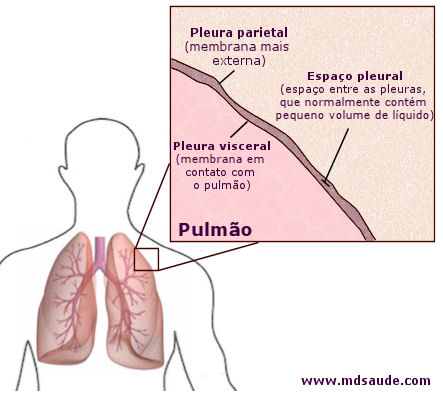 Derrame pleural