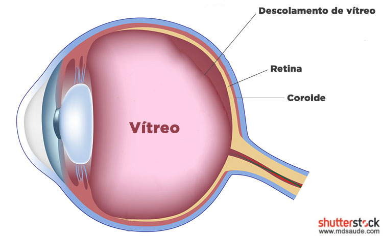 Descolamento de vítreo