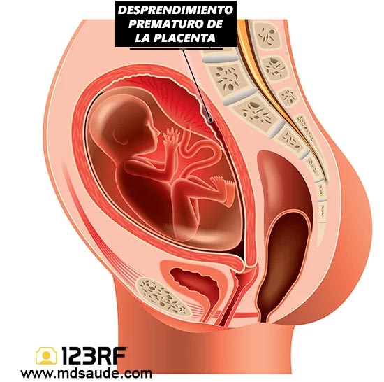 Desprendimiento de placenta