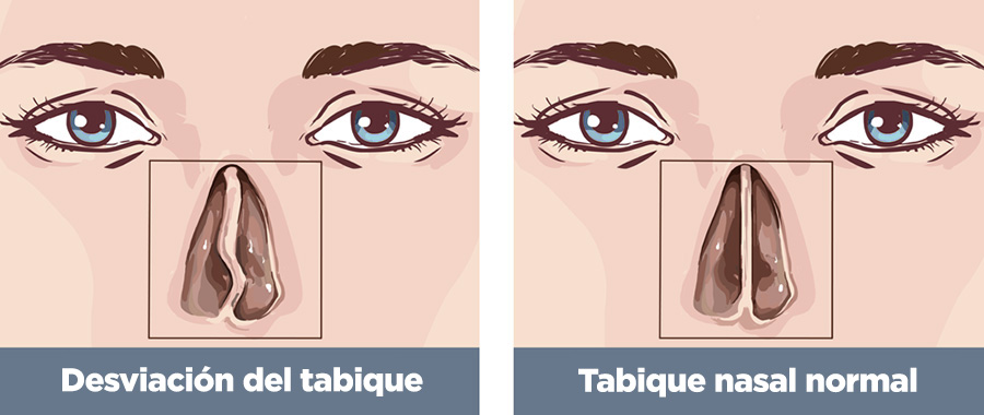 Desviación del tabique