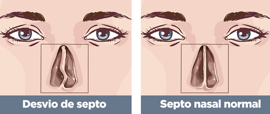 Desvio de septo