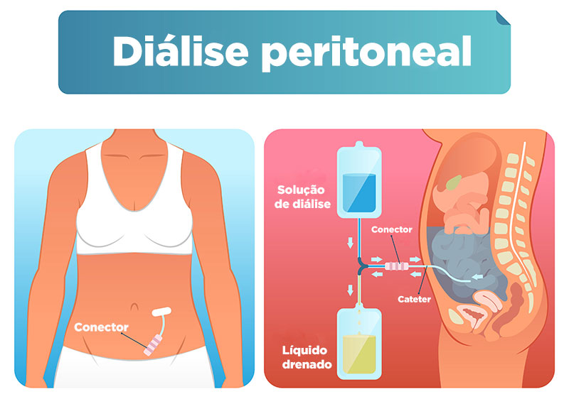 Diálise peritoneal