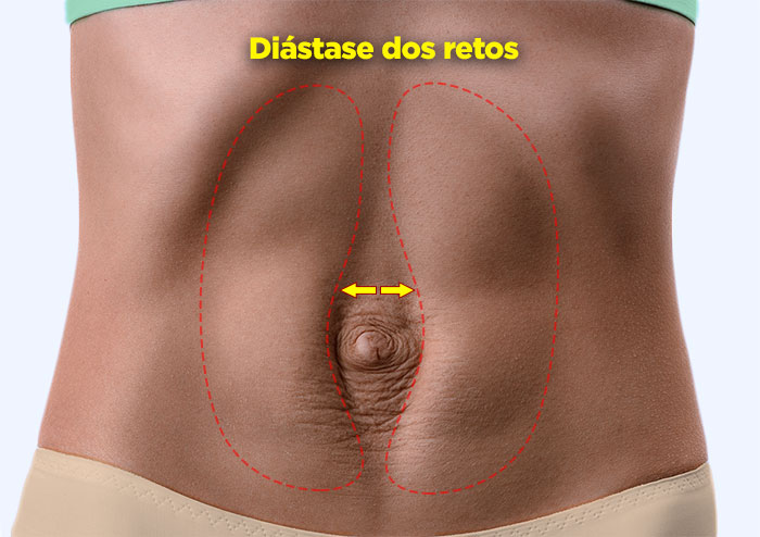 Diástase retal