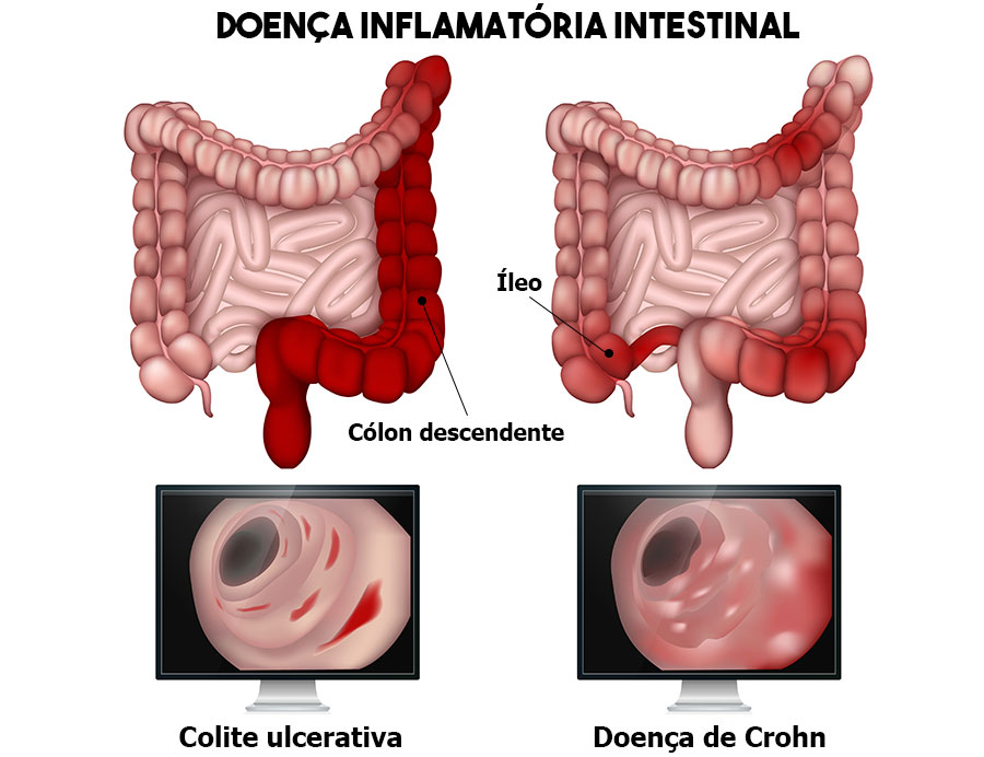 Doença inflamatória intestinal