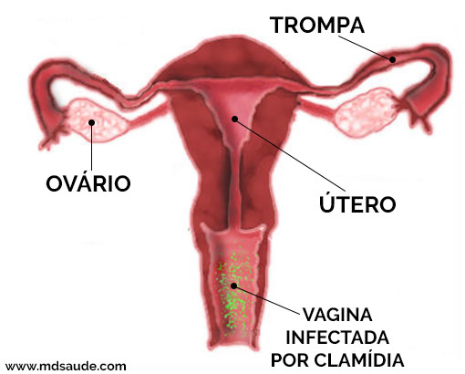 Infección vaginal