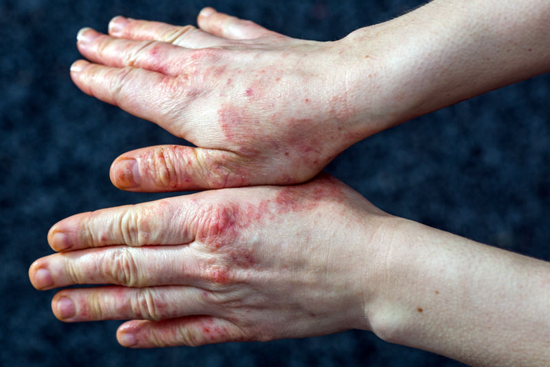 dermatite crônica nas mãos por eczema disidrótico.