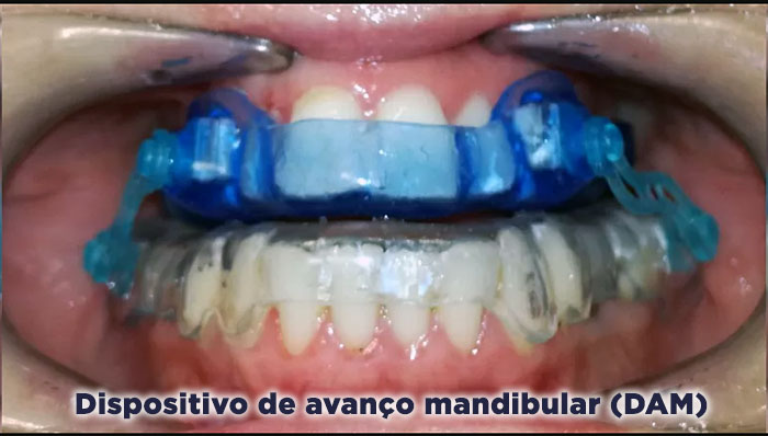 Dispositivo de avanço mandibular (DAM)