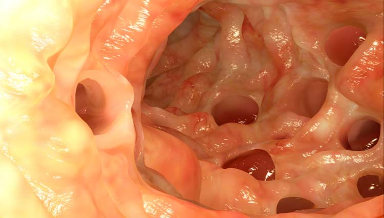 Divertículos