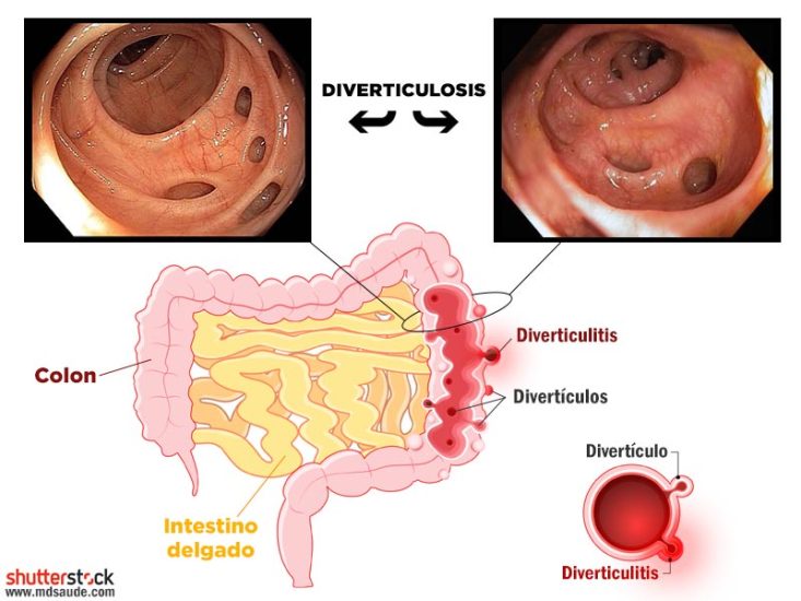 Diverticulitis y diverticulosis