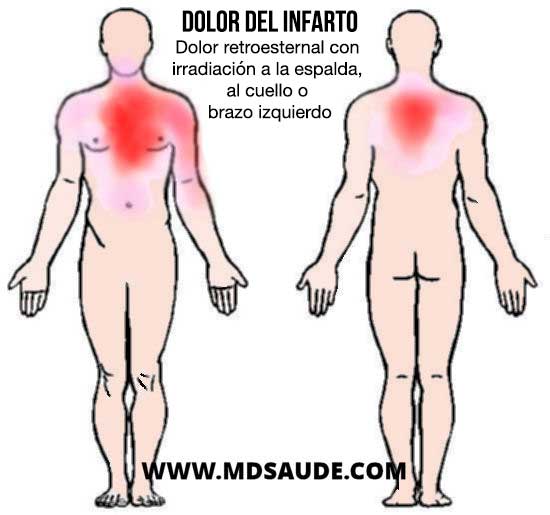 Localizaciones más típicas del dolor por infarto.