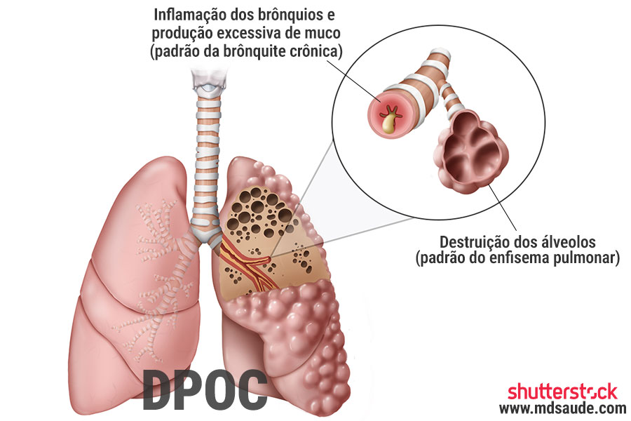 Padrões da DPOC