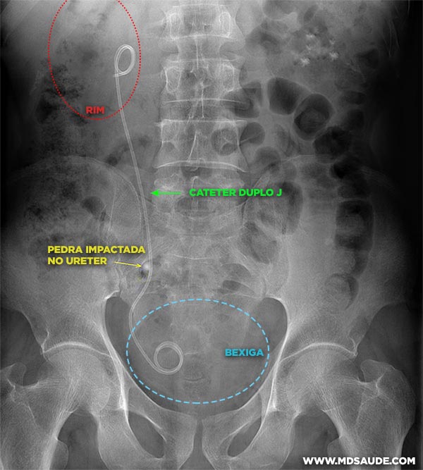 Cateter duplo J visto à radiografia simples de abdômen.